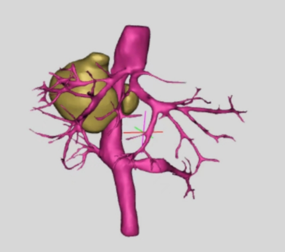 新华网>新闻>正文 三维重建模型手术如期进行,邰升教授带领团队兵分